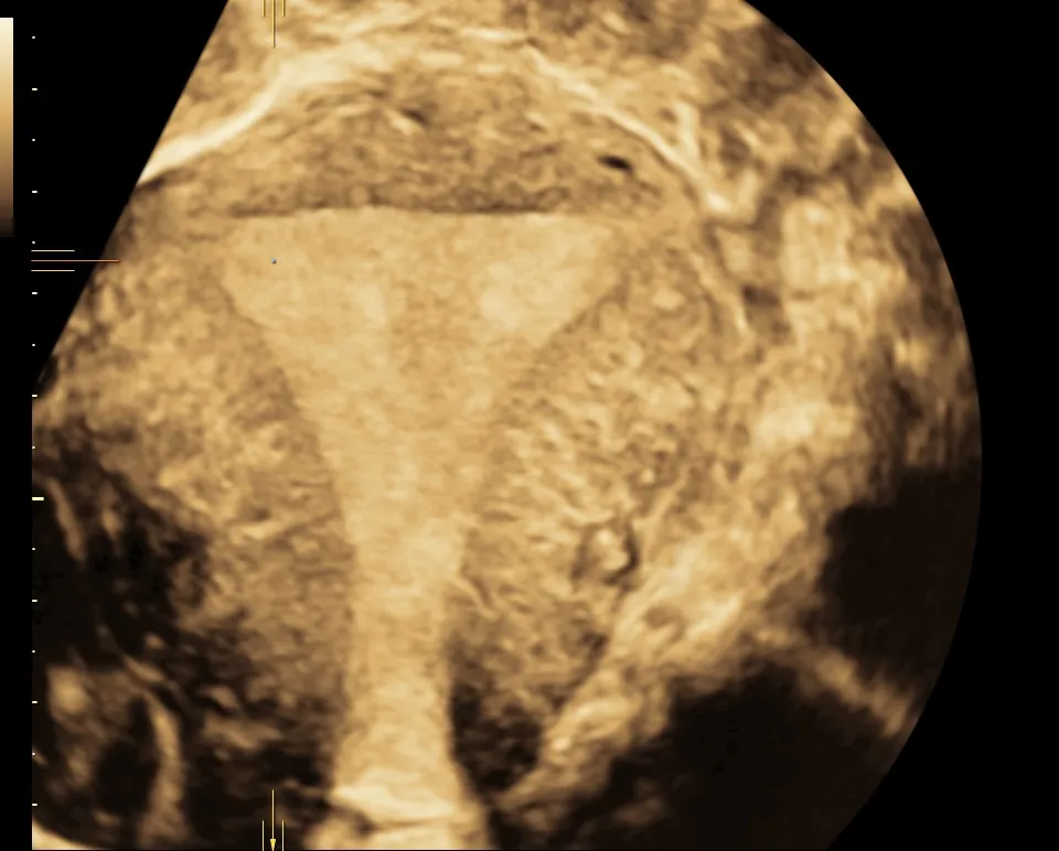 Échographie 3D réalisée au centre de fertilité de Boulogne-Billancourt